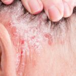 Benefits of Nettle: How to Reduce Inflammation in the Body Fast